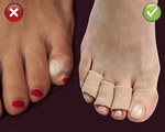FootCorrectors® set van 2, FootCorrector® brengt uw grote teen weer in de anatomisch juiste positie